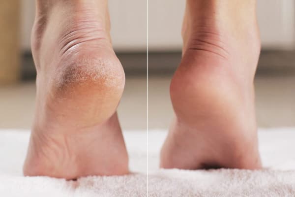 Гладкие пяточки с одного применения!